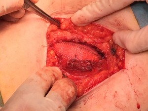 Implante de malla 2